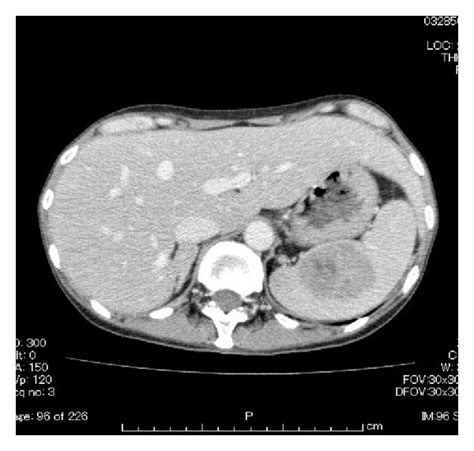 A Ct Showing Probable Spleen Metastasis B The Mass Found In The