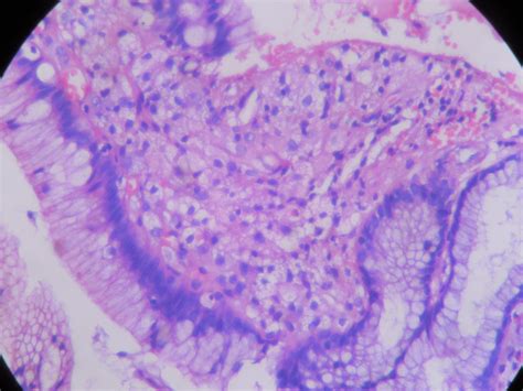 Gastric Xanthelasma Xanthoma Histopathologyguru
