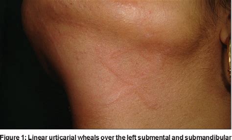 Figure 1 From Dermographic Urticaria Induced By Long Pulsed Diode Laser
