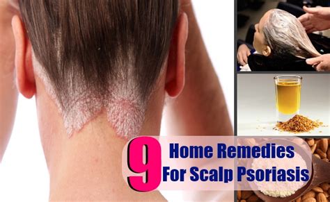 9 Scalp Psoriasis Home Remedies Natural Treatments And Cures Search