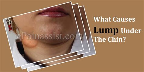Lump Under The Chin Causes And Treatment Options