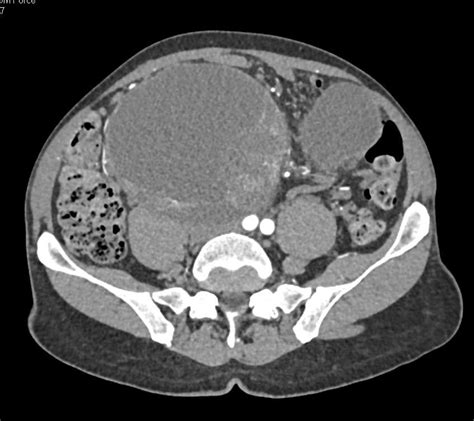 Testicular Teratoma With Large Cystic Nodes Genitourinary Case