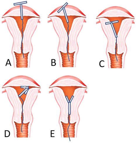 Women Body Structure Uterus