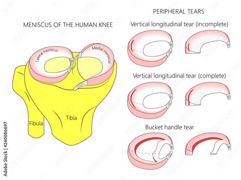 Vector Illustration Anatomy Of A Meniscus In The Healthy Human Knee