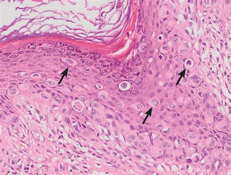 A Brownish Erythematous Patch In The Nipple Areola Complex Cleveland