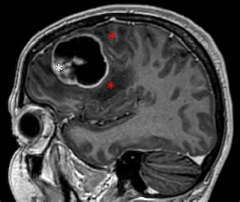 Frontiers Pro Inflammatory Cytokines In Cystic Glioblastoma A