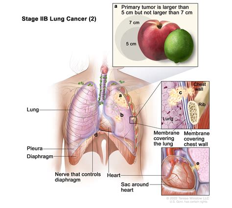 Non Small Cell Lung Cancer Treatment PDQ Health Professional Version Siteman Cancer Center