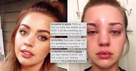 Woman Whose Popped Pimple Was Actually A Severe Skin Infection Shares