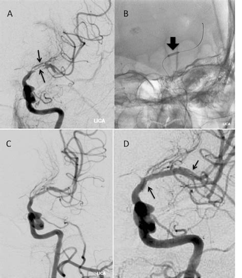 Figure 2 From Internal Carotid Artery Stenting For Intracranial
