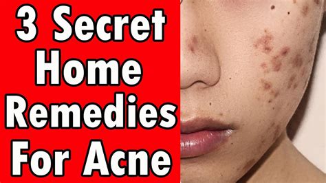 Powerful Home Remedies For Acne 3 Secret Treatments Revealed Youtube