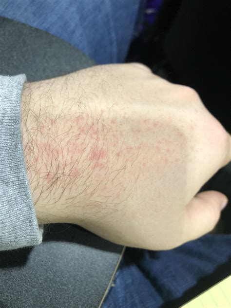 Recurring Rash On Both Hands In The Same Spot I Cant Identify A Cause