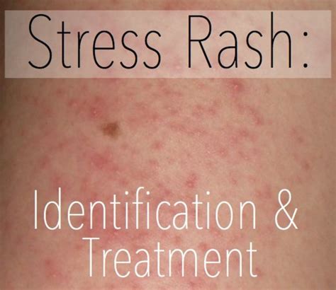 Stress As Related To Hives Pictures