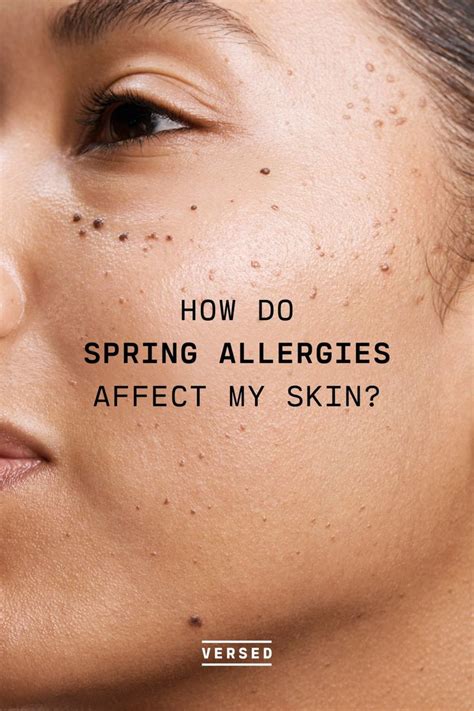 How Spring Allergies Affect Your Skin Spring Allergies Allergies