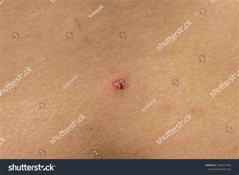 Photo Nodular Cystic Acne Skin Chronic Stock Photo 1969021843