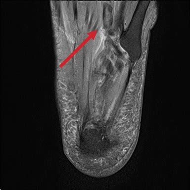 While the total volume of plantar intrinsic foot muscles was similar in healthy and plantar fasciitis feet, atrophy of the forefoot plantar. Foot Pain Caused by Plantar Vein Thrombosis - Charter ...