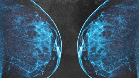 3d Mammogram Who Needs One What To Expect And Risks