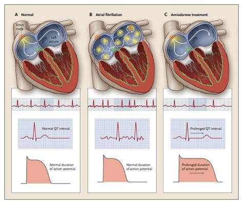 Antidsyrhthmic Medications Class Iii Potassium Channel Blockers Diagram Quizlet