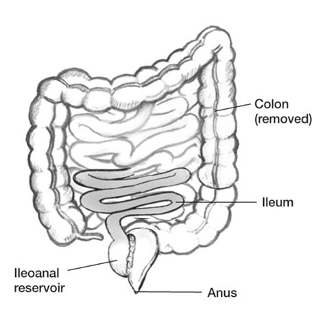 Ileoanal Reservoir With Labels For The Anus Ileum Removed Colon And