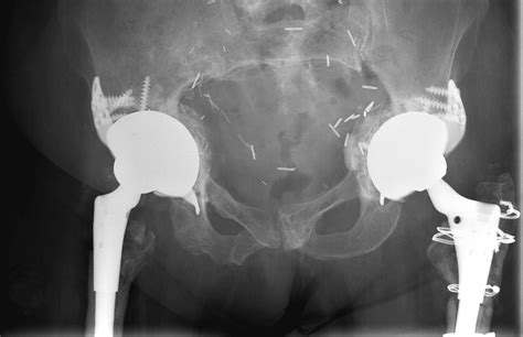 Acetabular Revision Using An Anti Protrusion Ilio Ischial Cage And