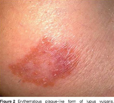 Figure 2 From Sarcoidosis Of The Skin A Dermatological Puzzle