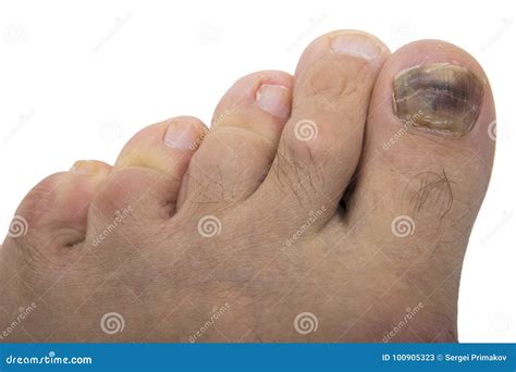 Nail Fungus Melanoma Stock Image Image Of Feet Chemotherapy 100905323