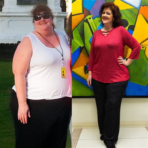 Weight Loss Surgery Before After Photos Soma Bariatrics Los Angeles
