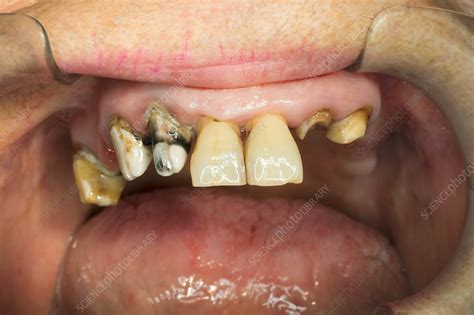 Severe Tooth Decay Stock Image C0333476 Science Photo Library