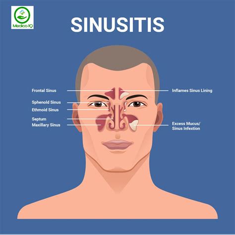 Sinusitis Causes Symptoms And Treatment Sinus Infection Medico Iq