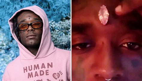 Lil Uzi Vert Says 24 Million Diamond Forehead Implant Ripped Out By