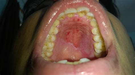 Pain And Swelling On The Roof Of My Mouth 12 300 About Roof
