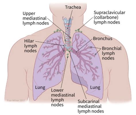 Non Small Cell Lung Cancer Staging Stages Of Lung Cancer