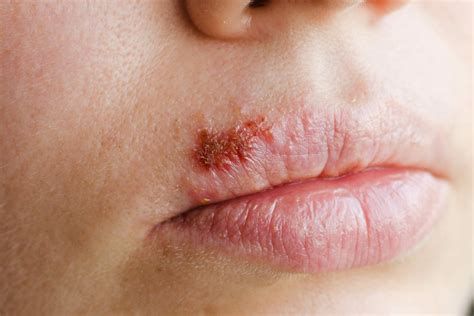 What Are Cold Sores Know The Signs Nabta Health