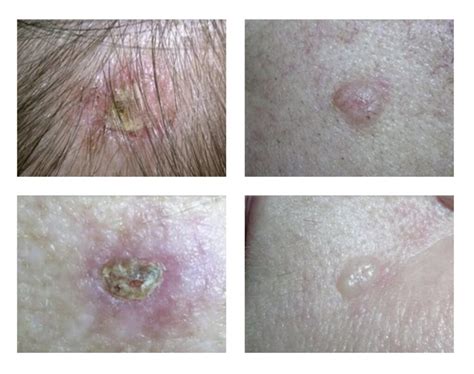 Рак кожи симптомы фото диагностика и лечение