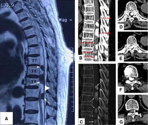 Frontiers Multiple Ossified Spinal Meningiomas In The Thoracic Spine