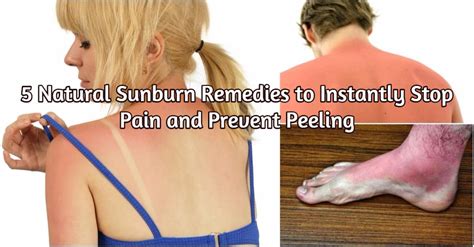 So the more often you get badly sunburned, the more apt you are to get skin cancer, especially melanoma, the skin cancer that kills 1 american every 55. 5 Natural Sunburn Remedies to Instantly Stop Pain and ...