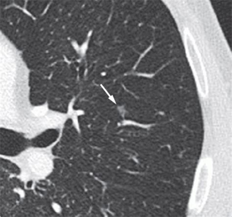 Tumors Of The Lung Radiology Key