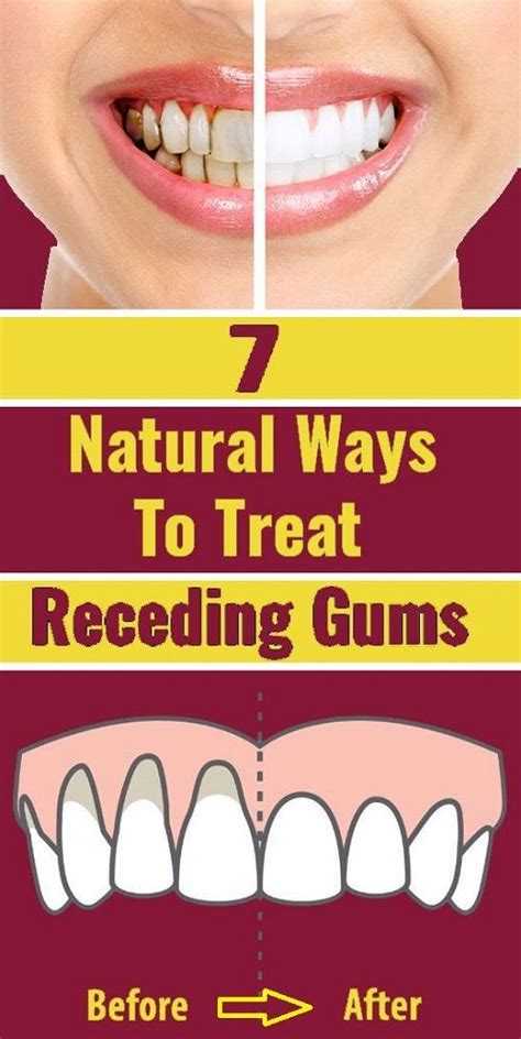 7 Natural Ways To Treat Receding Gums • Healthy Group Receding Gums