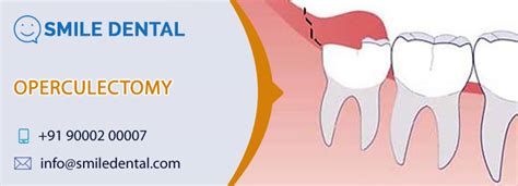 Operculectomy In Dilsukhnagar Smile Dental