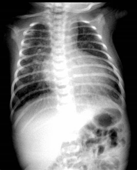 The primary arteries (the aorta and the pulmonary artery) are transposed. Transposition of the Great Arteries (TGA) - Pediatrics ...