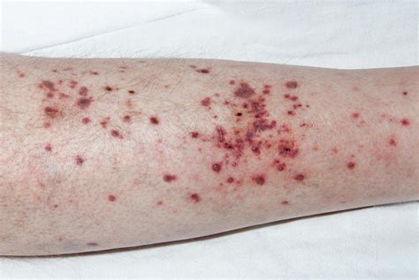 Pictures Of Vasculitis On Skin