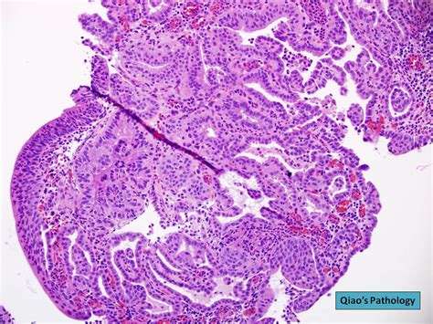 Qiaos Pathology Cystitis Glandularis Microscopic Photo S Flickr