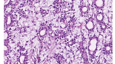 Adenoma Pleomórfico Patologia Bucal