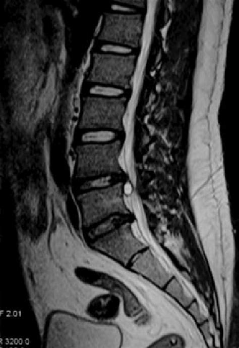 Sagittal Mri Lumbar Spine