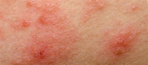 Abrocitinib Looks Promising In Phase 3 Atopic Dermatitis Trial