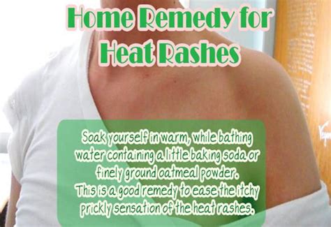 Home Remedy For Heat Rashes Home Remedies Remedies Mama Natural