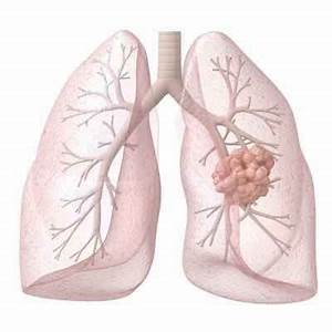 What Causes Lung Cancer? Lung Cancer  