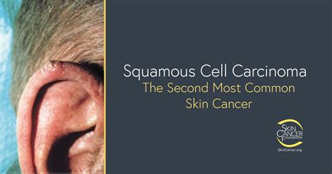 Carcinoma A Cellule Squamose The Skin Cancer Foundation