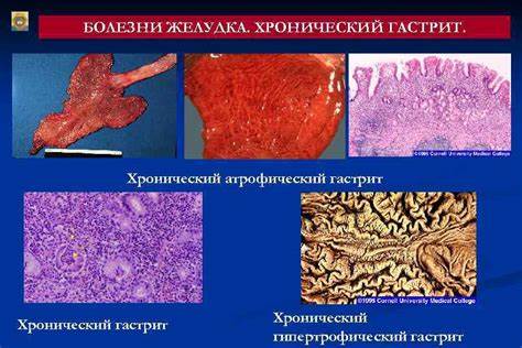 Диета гиперпластический гастрит