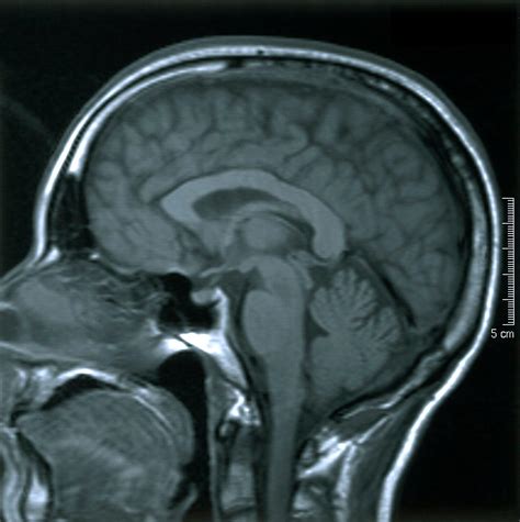 Normal Brain 6 Sagittal Mri Scan Wellcome Collection