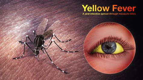 Yellow Fever Shown And Explained Using Medical Animation Still Shot